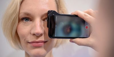 Che cos’è il glaucoma