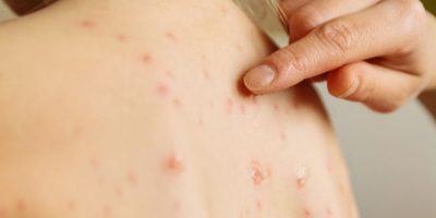 Morbillo, nei primi tre mesi dell’anno 55...