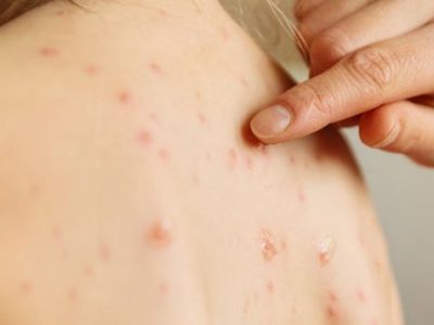 Morbillo, nei primi tre mesi dell’anno 557 casi in Italia