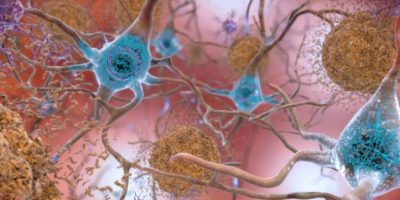 Alzheimer, scoperto il meccanismo che accelera ...