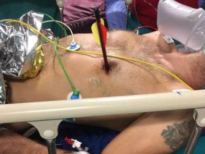 Cuore trappassato da un freccia di 30 cm, il paziente è salvo