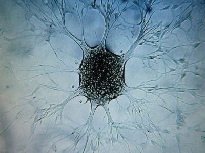 Uno studio italiano scopre la proteina che nutre i tumori