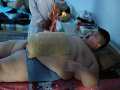 Uno studio italiano per perdere peso attraverso scosse al cervello