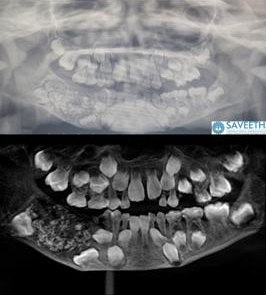 La radiografia dei 526 denti del bambino