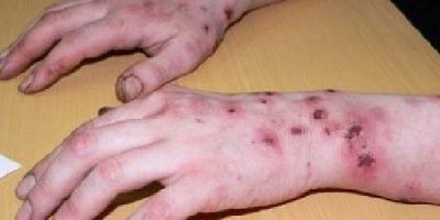 Arrestato spacciatore di Krokodil, la nuova dro...