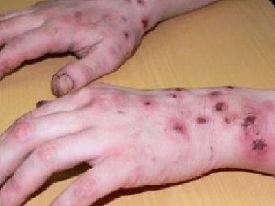 Arrestato spacciatore di Krokodil, la nuova droga “che ti mangia”