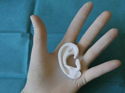 Primo caso italiano di orecchio in 3D, nuova frontiera della chirurgia