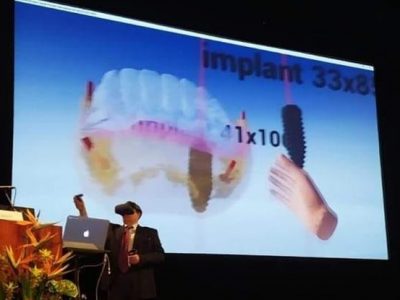 VRubino, il nuovo software in 3D per gli impianti ai denti