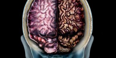 Essere nevrotici aumenta il rischio di sviluppa...