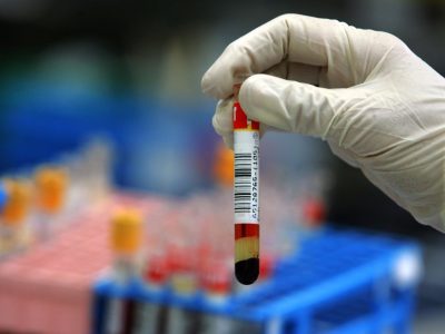 Scoperto un nuovo ceppo del virus Hiv, è denominato Hiv-1 gruppo M sottotipo L