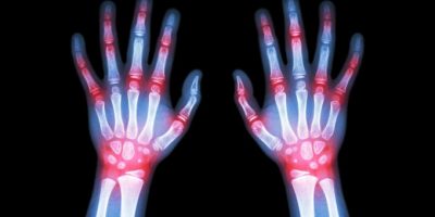 Artrite reumatoide: insorge tra i 30 ed i 50 an...