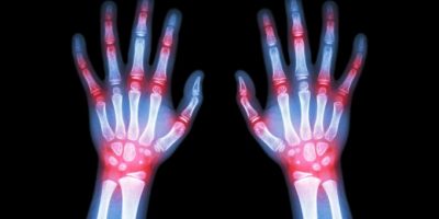 Artrite reumatoide: insorge tra i 30 ed i 50 an...