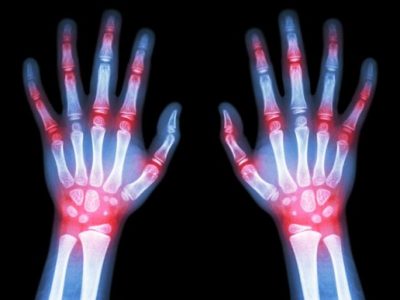Artrite reumatoide: insorge tra i 30 ed i 50 anni, colpisce circa 400mila italiani