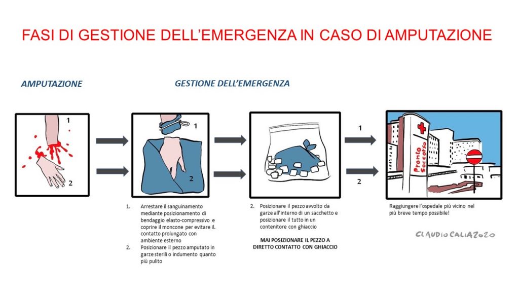 padova mano amputata