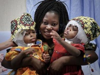 Roma, al Bambino Gesù separate due gemelline siamesi unite per la testa