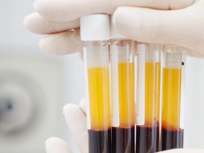 La Food and drug administration concede l’uso del plasma contro il virus