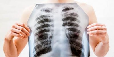 Infiammazioni polmonari da Covid, un aiuto arri...