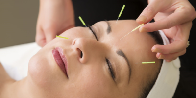 Agopuntura, che cos’è e quali sono i suoi benefici