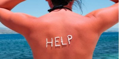 Rimedi naturali contro le scottature solari