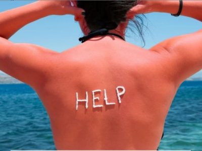 Rimedi naturali contro le scottature solari